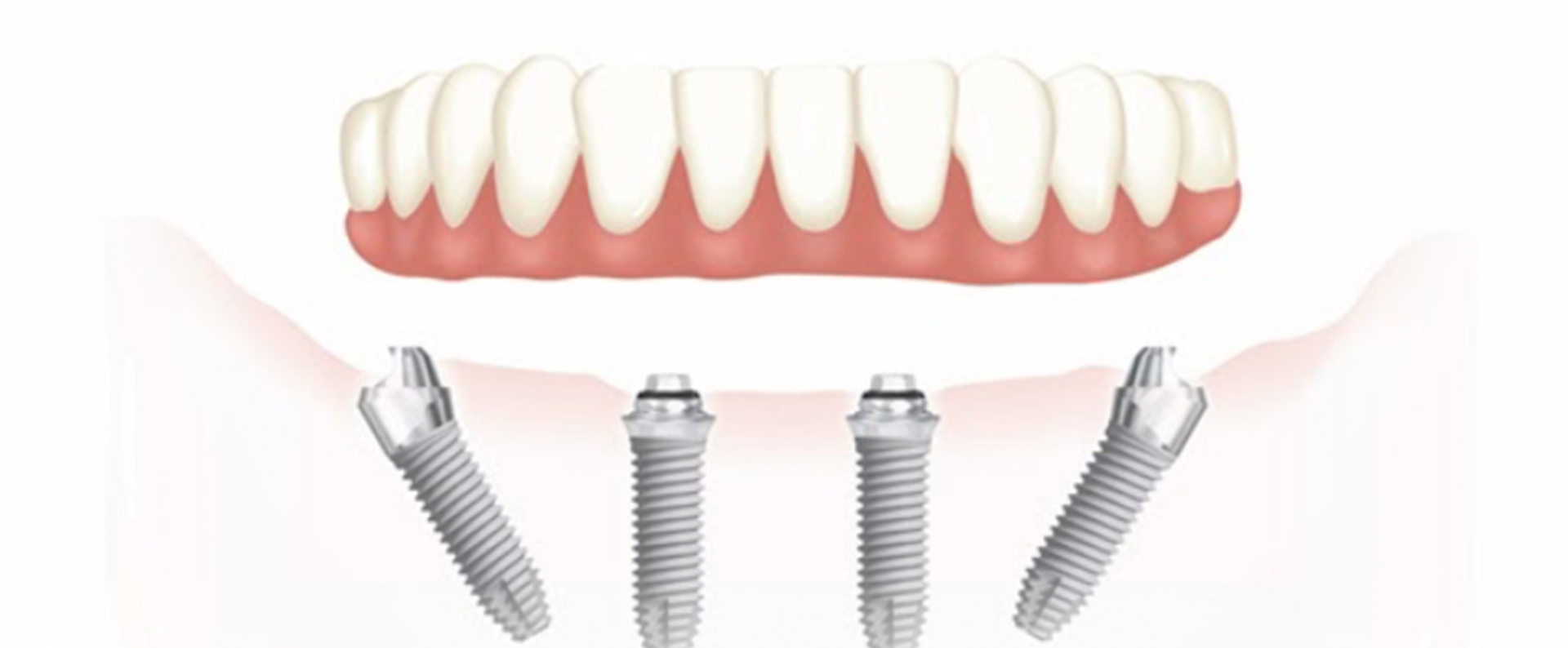 Имплант зуба Osstem. Имплантация all on 4 челюсть. Одноэтапная имплантация all-on-4.